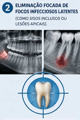 2. Eliminação focada de focos infecciosos latentes (como sisos inclusos ou lesões apicais)